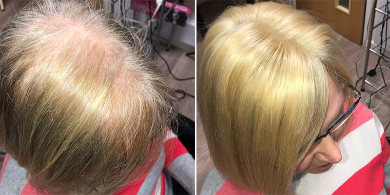 Hair Integration Before And After
